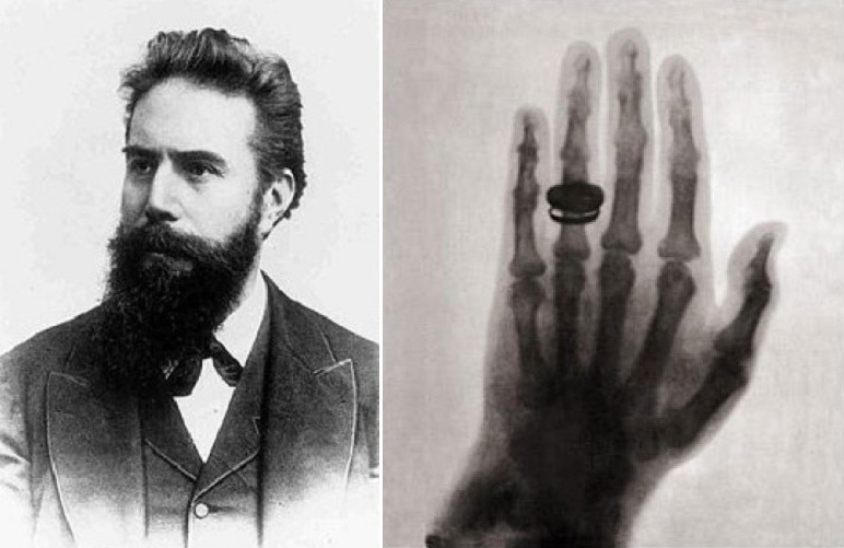 La prima radiografia medica fu eseguita da Röntgen il 22 dicembre 1895 alla mano sinistra della moglie Anna Berthe
